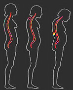osteoporosis figure