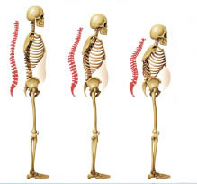 osteoporosis posture