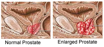 prostate glands